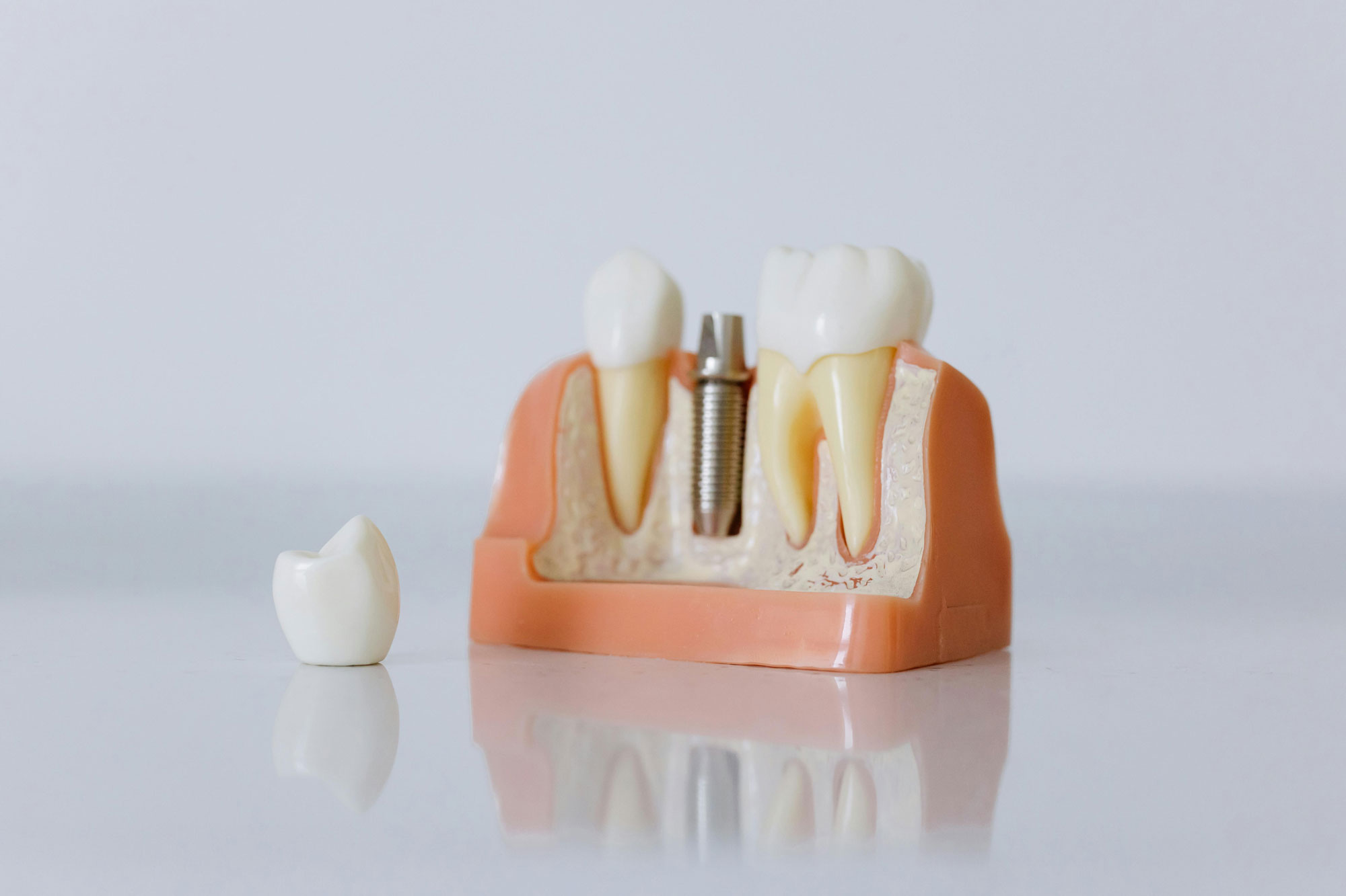 Dental Bridges Dental Bridges
