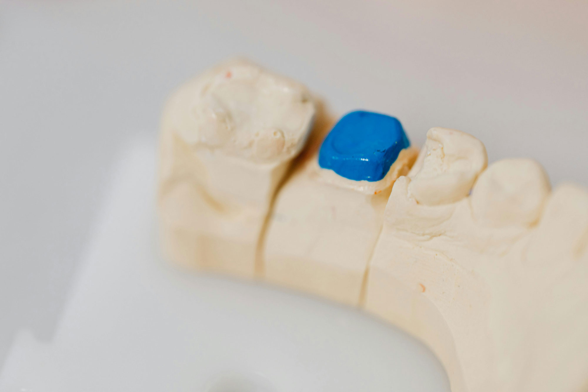 Dental Fillings Dental Fillings